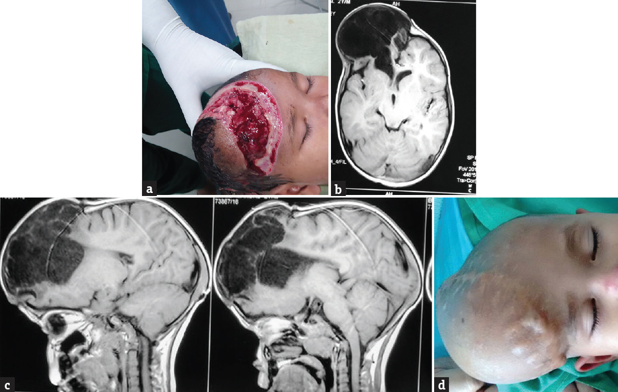 (a) Brain fungus, (b) magnetic resonance imaging axial cut showing porencephalic cyst, (c) magnetic resonance imaging sagittal cut, (d) postoperative porencephalic cyst